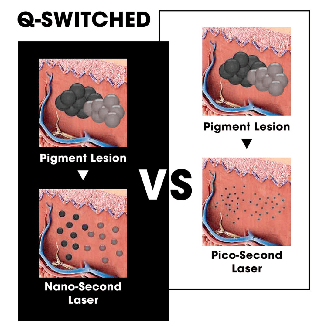 Q switch laser machine - Image 5