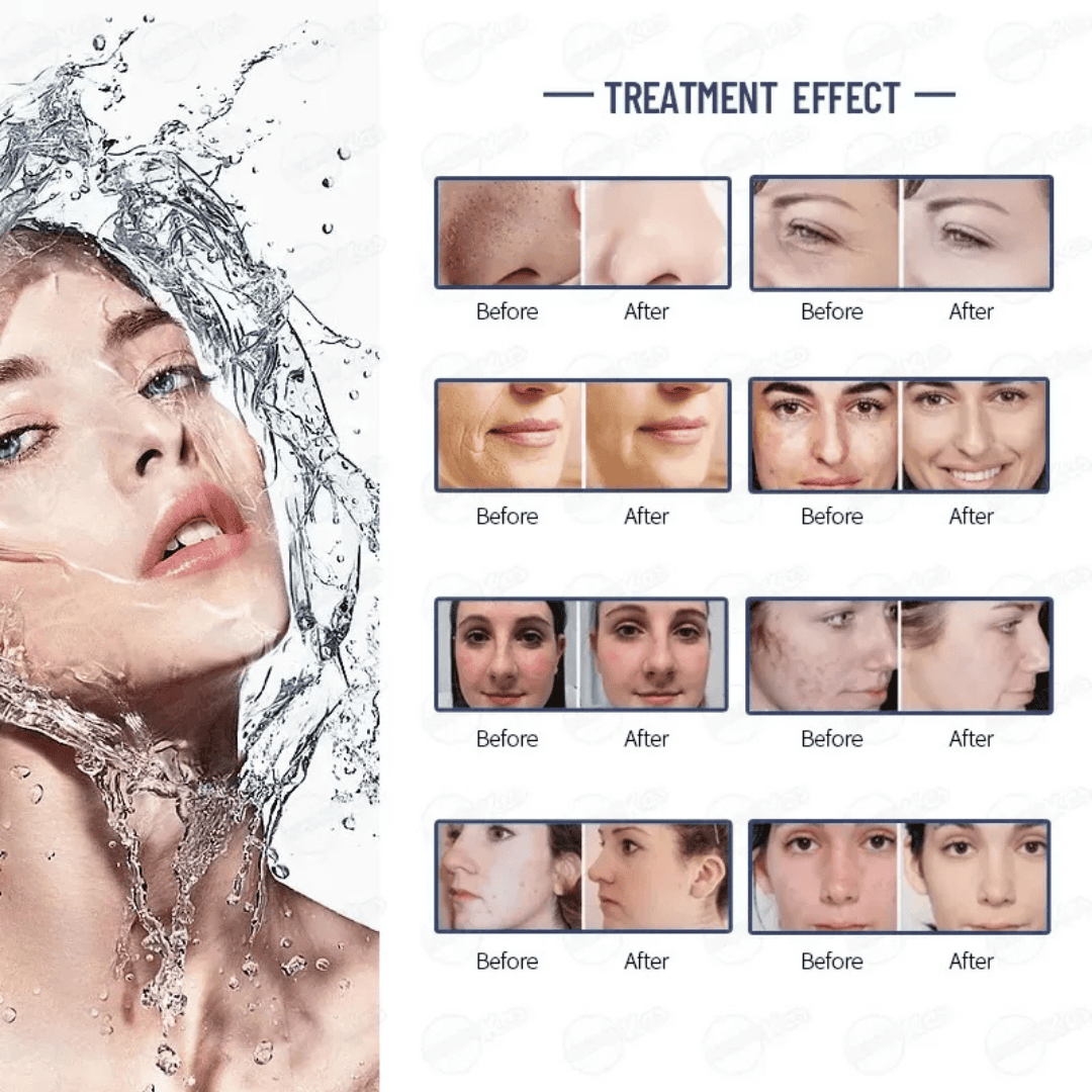 HydraFacial Machine - Image 4