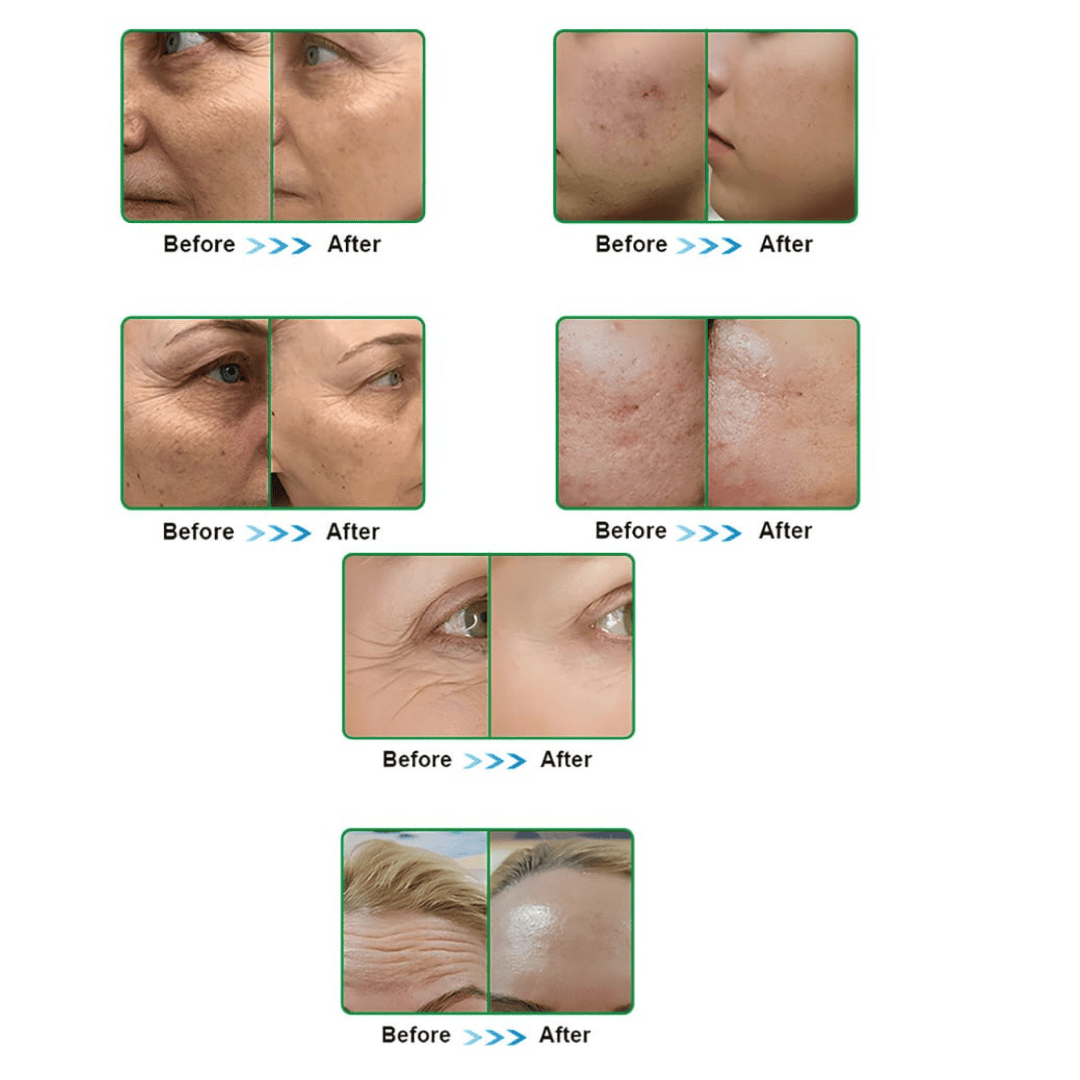 MNRF Micro Needling RF Machine - Image 7