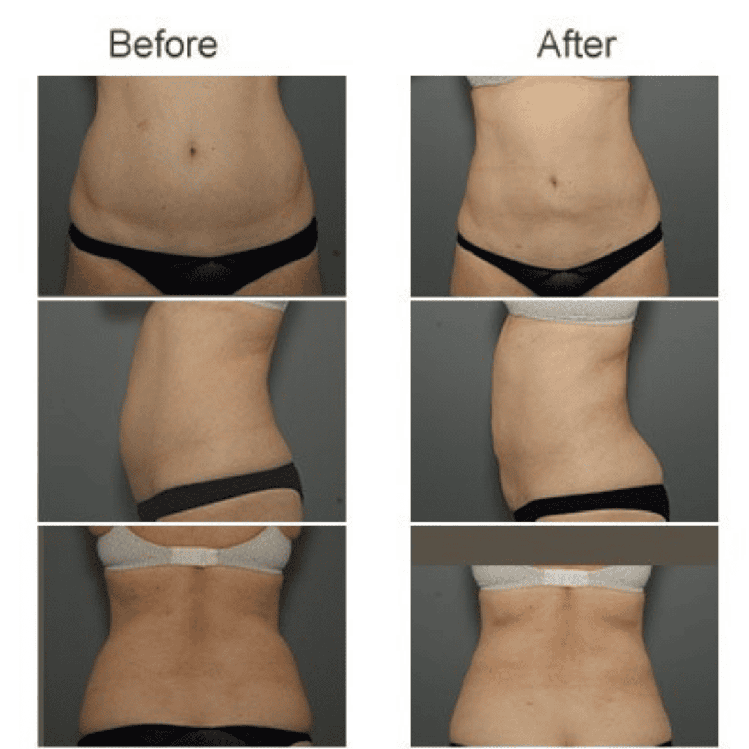 Lipo laser - Image 6